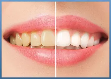 Teeth Whitening Dentist Meriden CT